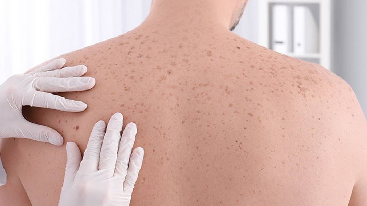 Uzmanlardan cilt kanseri uyarısı: Vakalar artıyor, önlem alın