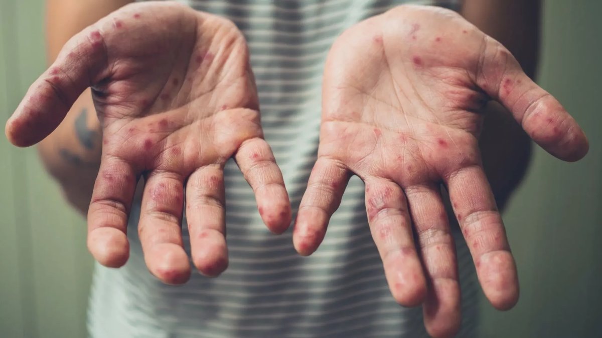 M çiçeği salgınında korkutan artış: Yetkililer acil müdahale çağrısında bulundu