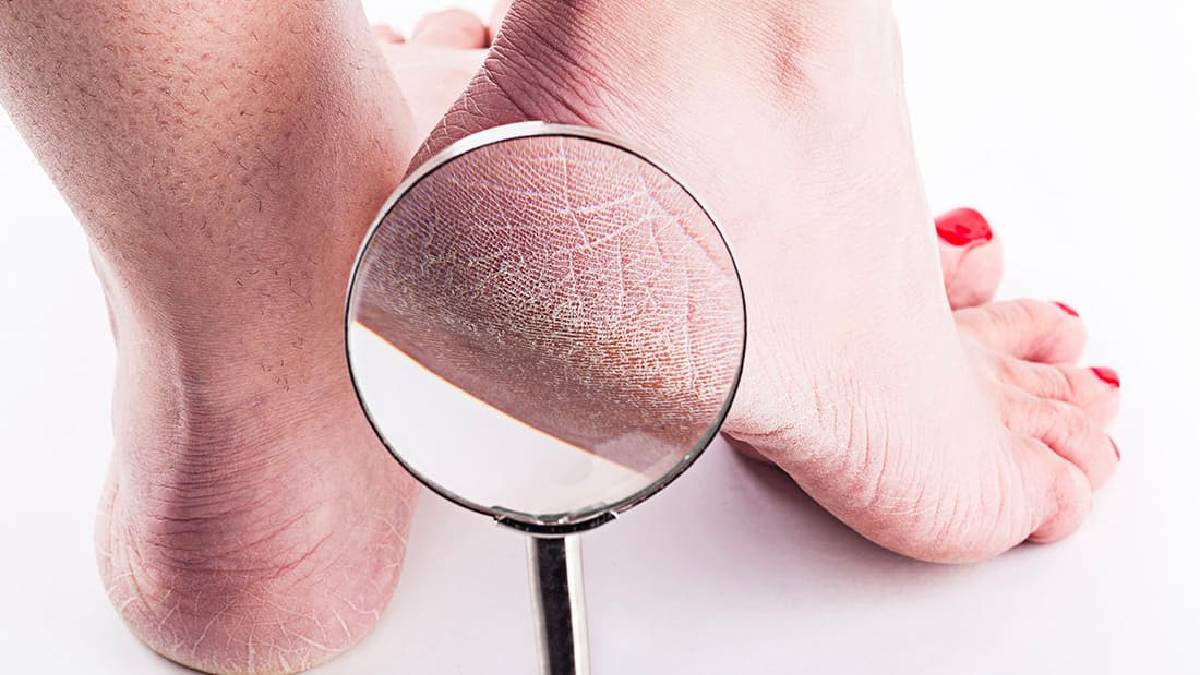 Çatlayan topuklara doğal çözüm! Törpülemeden yumuşacık yapacak yöntem: 3 günde farkı göreceksiniz!