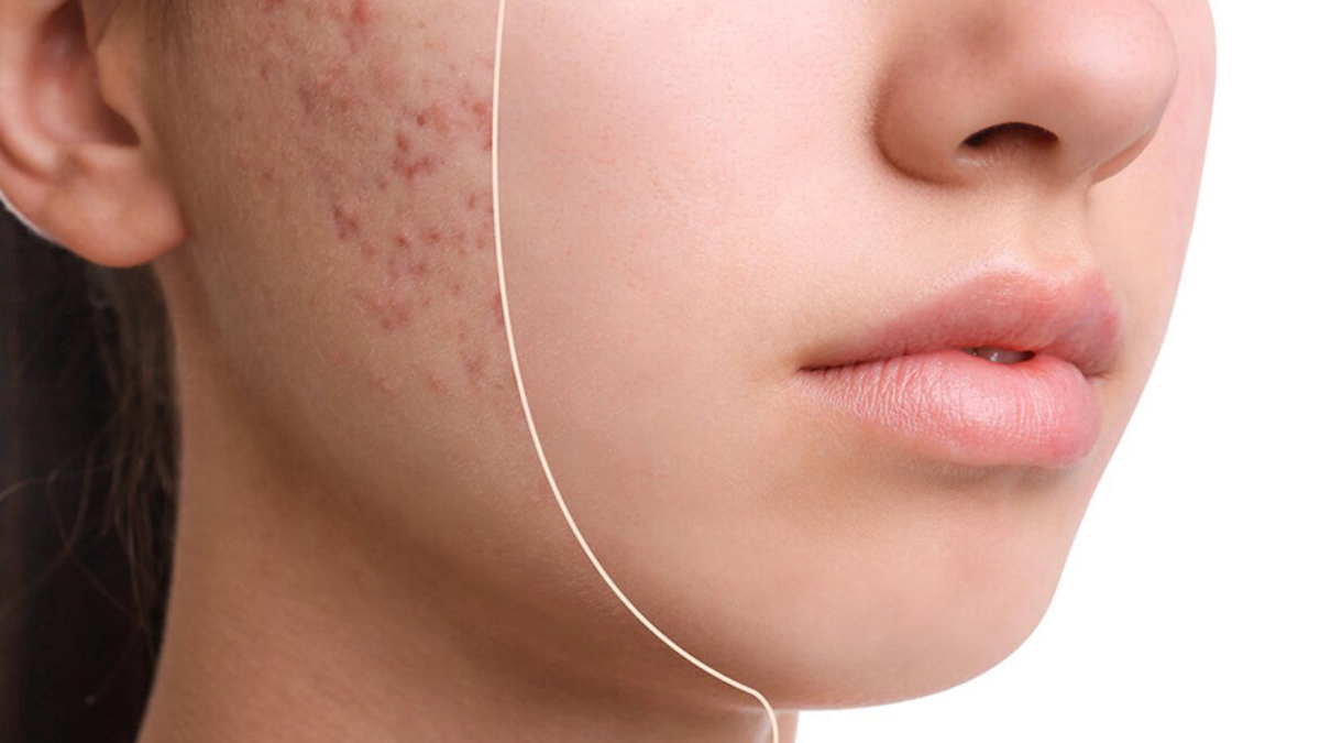 Lekeleri azaltıyor, cildi yeniliyor! Evde sadece 2 malzemeyle sivilcelere ve lekelere elveda!