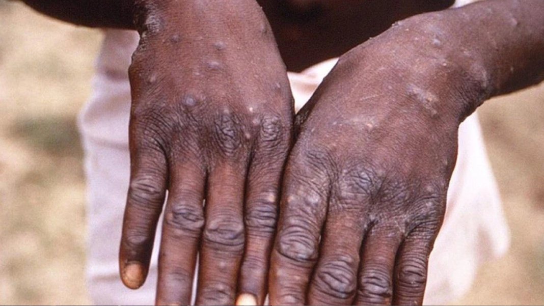 Gana'da M çiçeği vakası tespit edildi