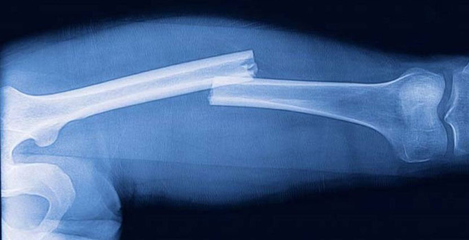 Kemik kırıklarına ‘bor’lu çözüm