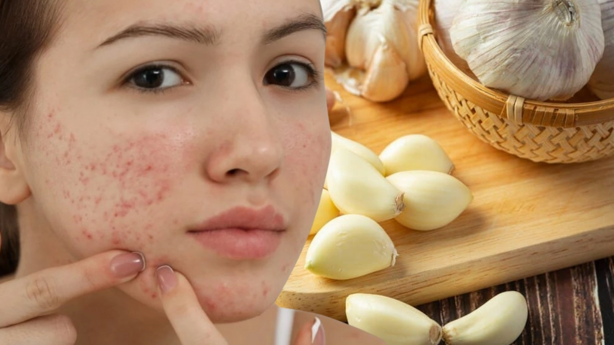 Sosyal medyanın yeni akımı! Sivilceleri yok ettiği iddia ediliyor: Kullanıcılar her gün bir tane yiyor