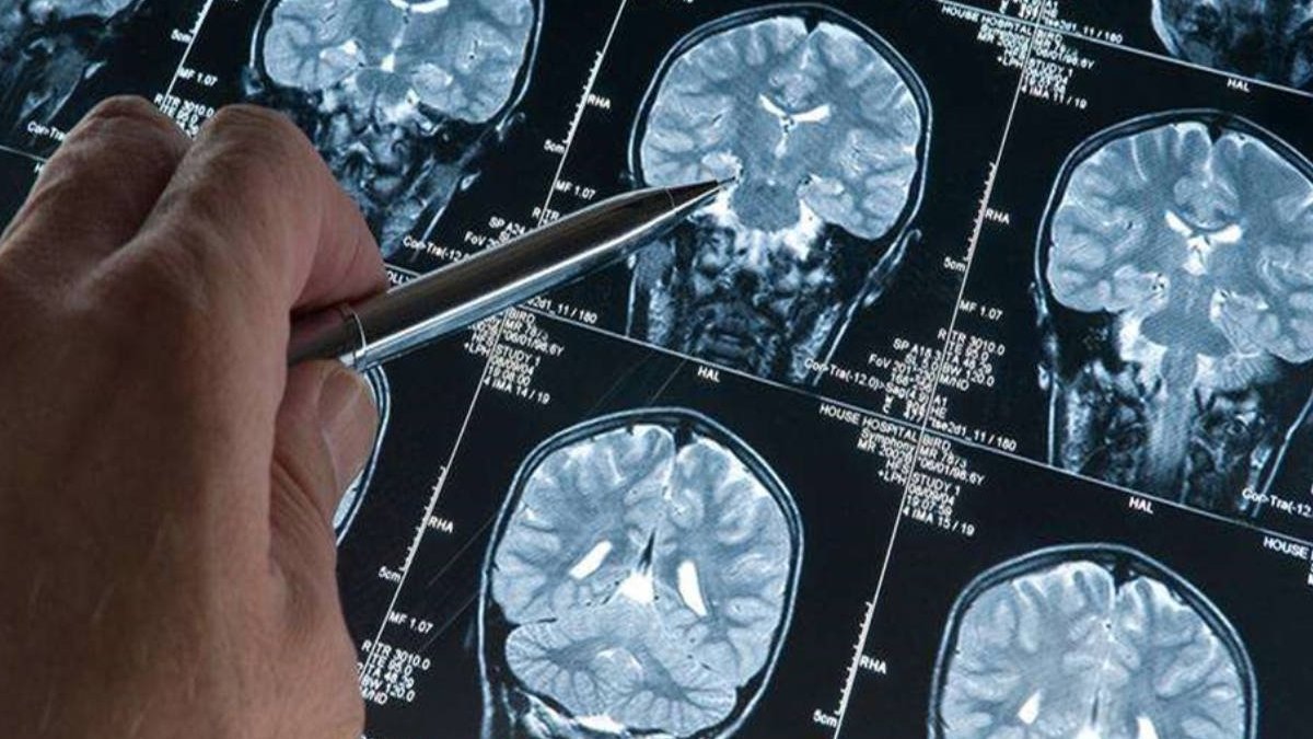 Alzheimer teşhisinde devrim: Kan testiyle erken tanı mümkün