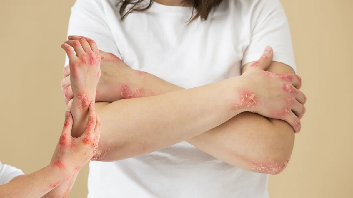 Mantar ve egzama probleminin kökünü kazıyan evdeki gizli şifa! 1 damlası yeter, cildinizde mucizeyi görün