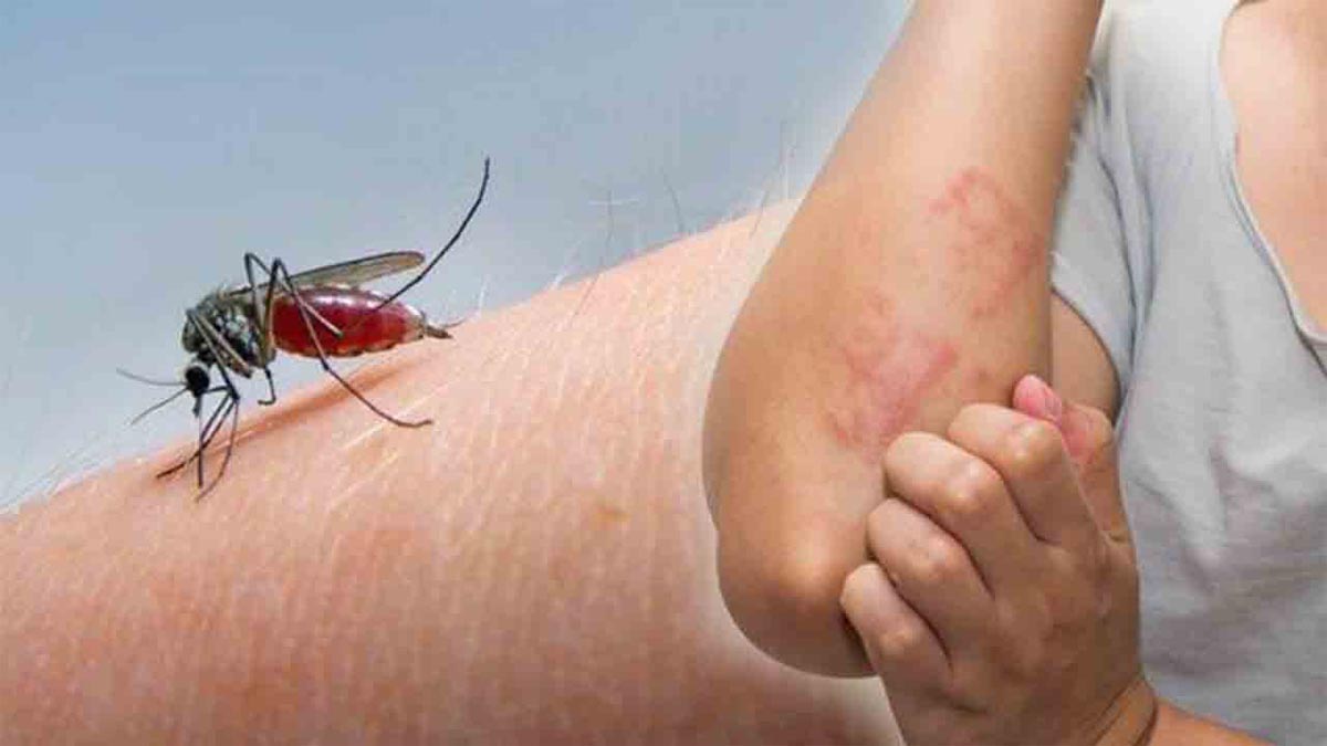 Sivrisinek ısırıkları yaz keyfinizi mahvetmesin! Sivrisinek kaşıntısından kurtulmak için bu doğal yöntemleri kaçırmayın!