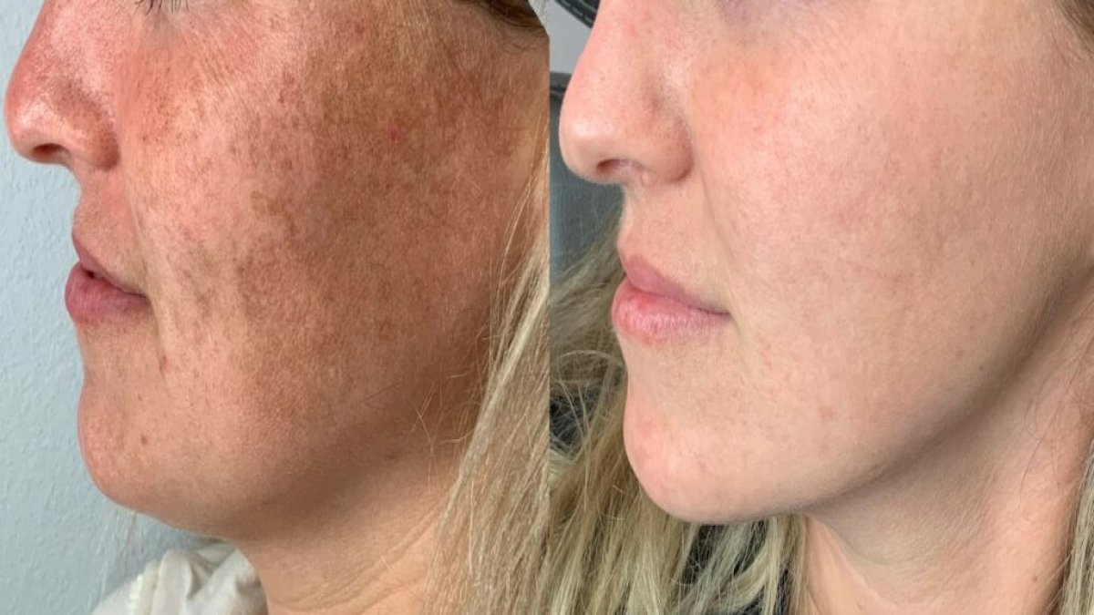 Yazın cilt yaşlanmasını önlemenin yolu: Uzmanından güneşten doğru korunma rehberi