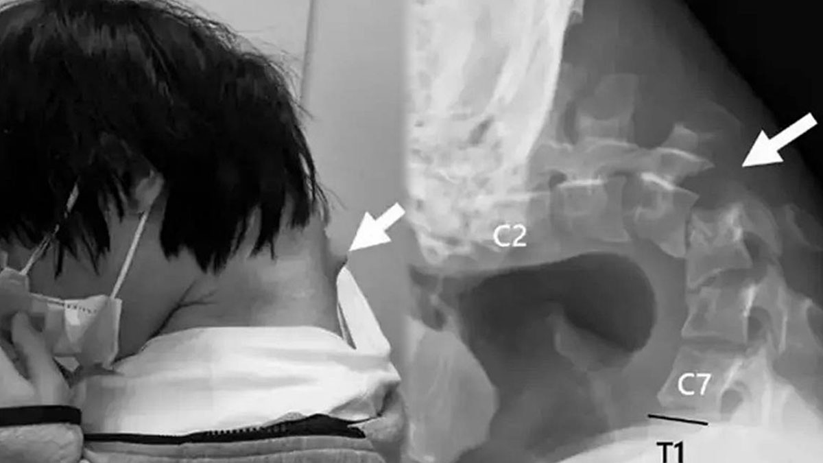 Sanal dünya, gerçek felaket: Telefon bağımlısı gencin boynu tamamen yamuldu! Sürekli telefona bakmak bakın ne hale getiriyor...