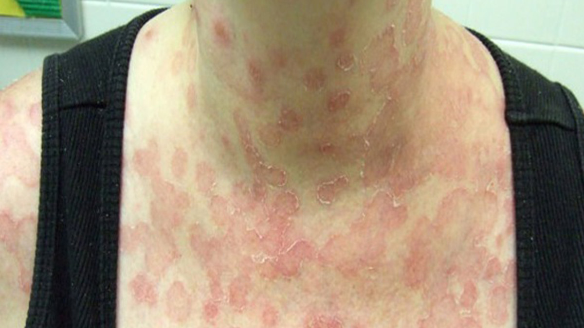 İhmal edilen gül hastalığı kalıcı damar sorunlarına neden olabilir