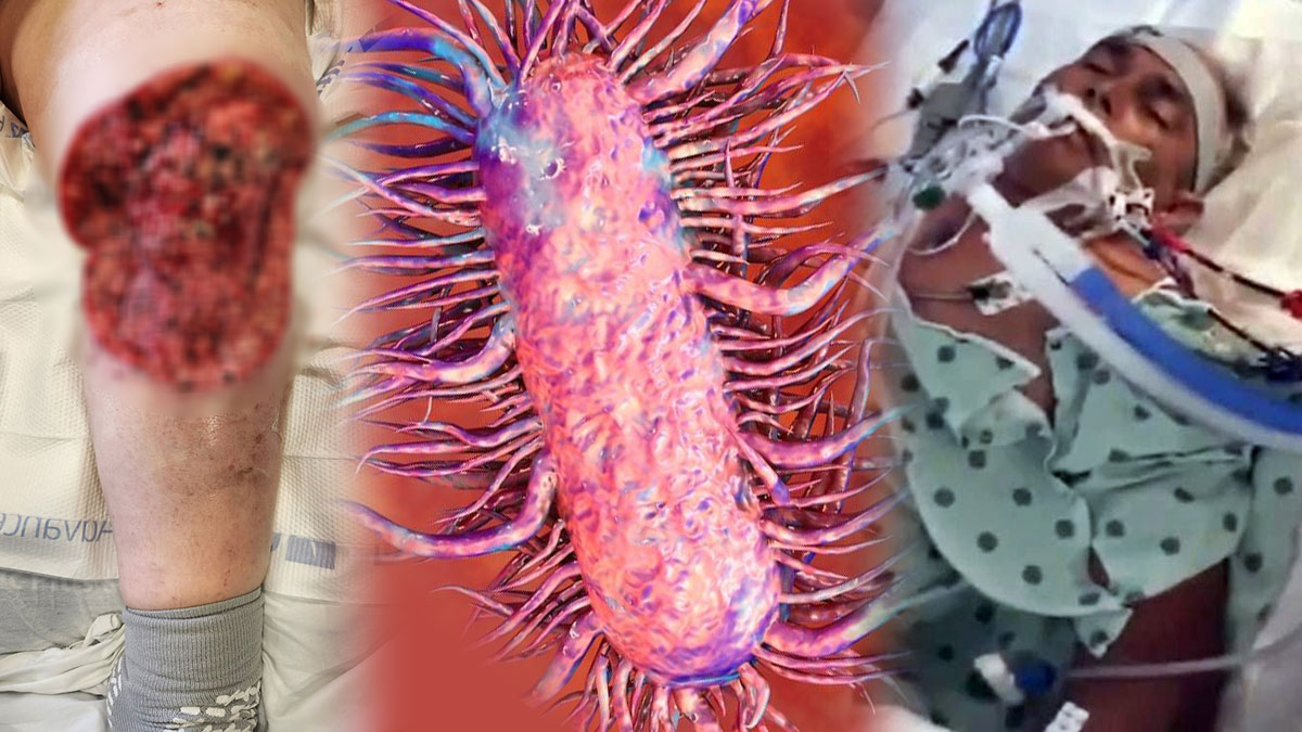 Denizde gizlenen tehlike: 4 kişiyi öldürdü! Et yiyen bakteri riski artıyor, işte bilmeniz gerekenler...