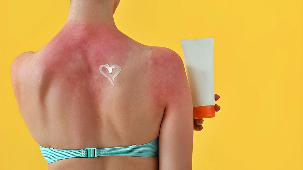 Yazın en sinsi tehlikesi: Cilt sağlığı için bunu göz ardı etmeyin! Güneş yanığı sandığınız şey aslında başka bir şey olabilir