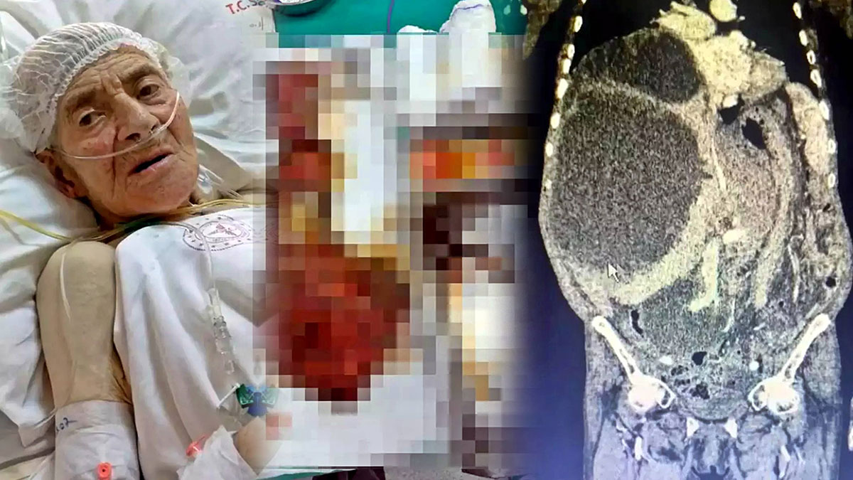 Karnından 90 santimetrelik kedi-köpek kisti çıkarıldı! Karın şişliğiyle gitti, doktorlar da şaştı kaldı