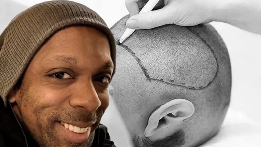 İstanbul'da estetik operasyonun ardından ölüm: Saç ekimi için geldi, hayatını kaybetti