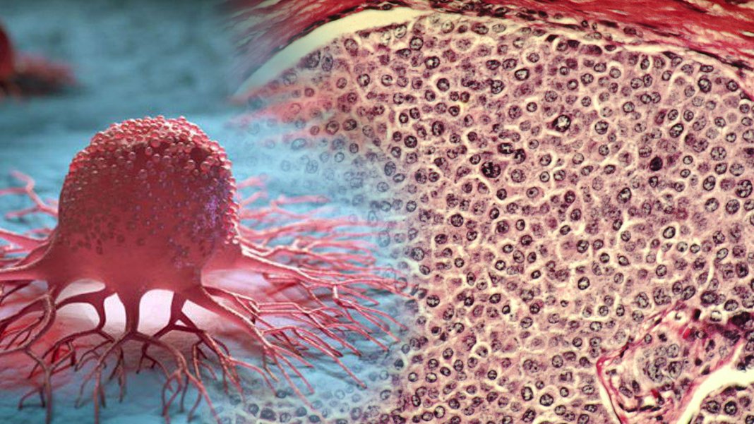 Kanser tedavisinde çağ açan buluş: İki bakterinin karışımı, kanserli tümörleri tamamen yok etti