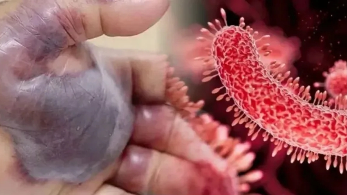 Et yiyen bakteri kabusu türkiye sahillerinde! Bu belirtileri görürseniz denize sakın girmeyin