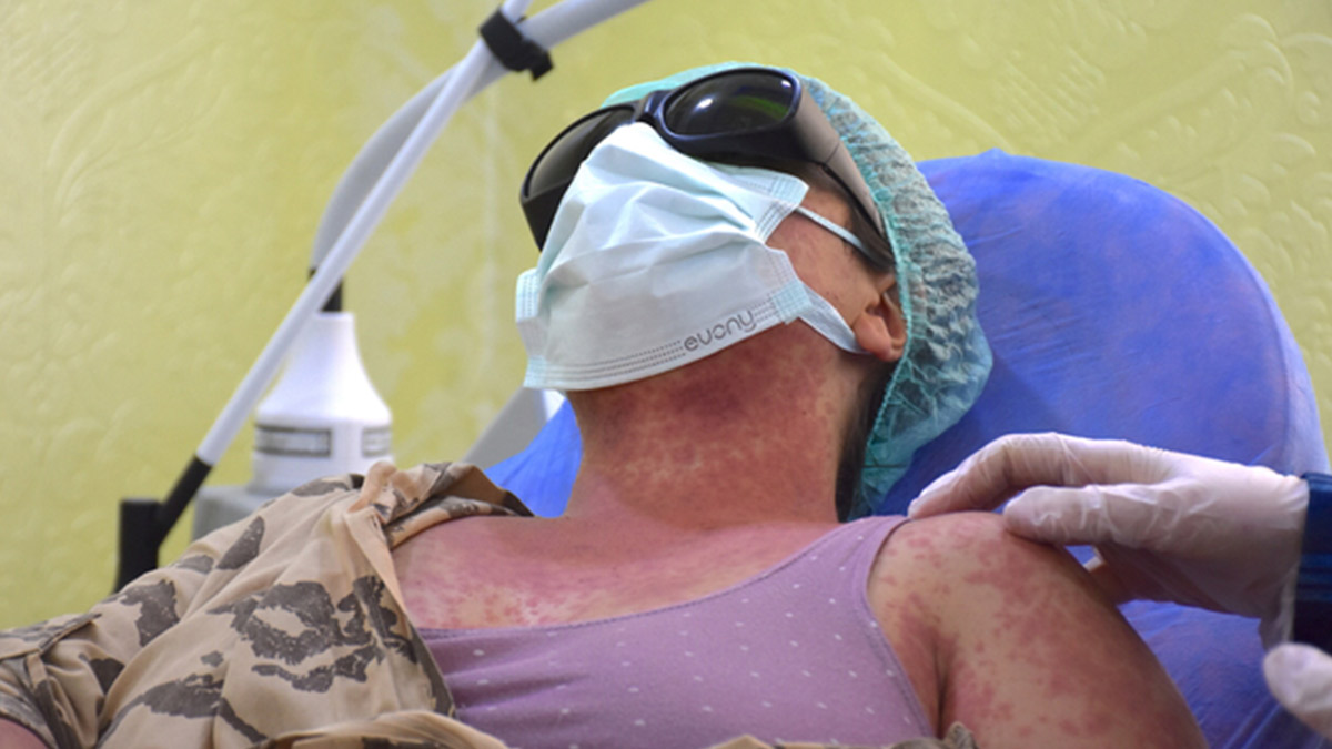 Van'da 4 kişi sivilce kreminden hastanelik oldu