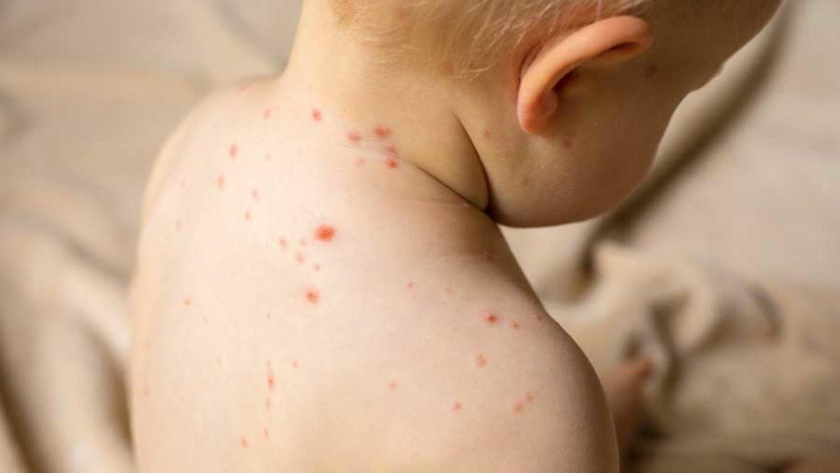 Bebekken geçirdi ardından iyileşti! Masum bir hastalık sanıldı, 10 yıl sonra hayattan kopardı: Bir annenin yürek yakan uyarısı