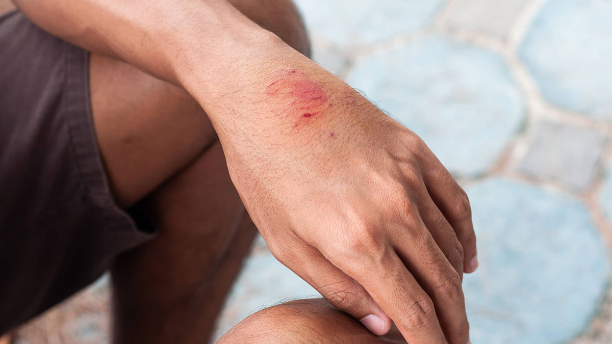 Türkiye seyahati sonrası kuduz şüphesi vakaları artıyor! Hollanda sağlık kurumu duyurdu