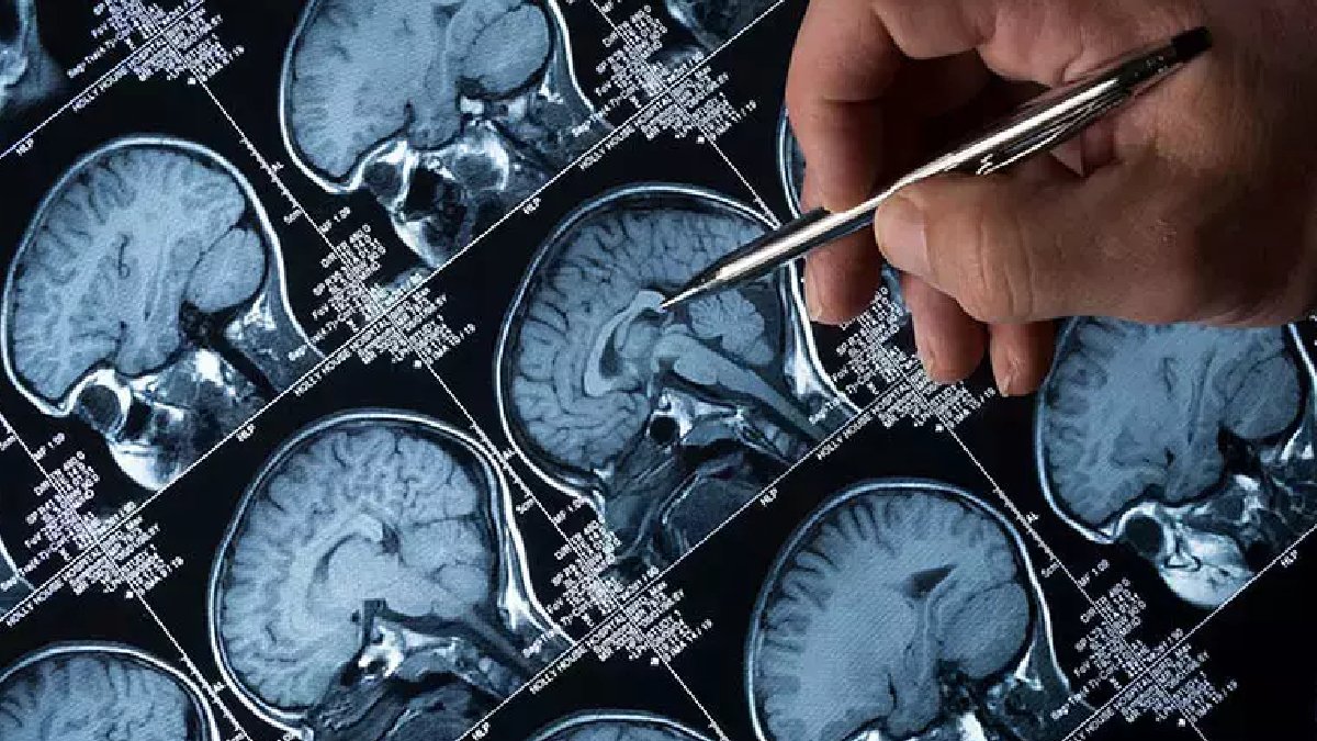 Yeni araştırma: Lityum Alzheimer’a karşı beyni koruyor