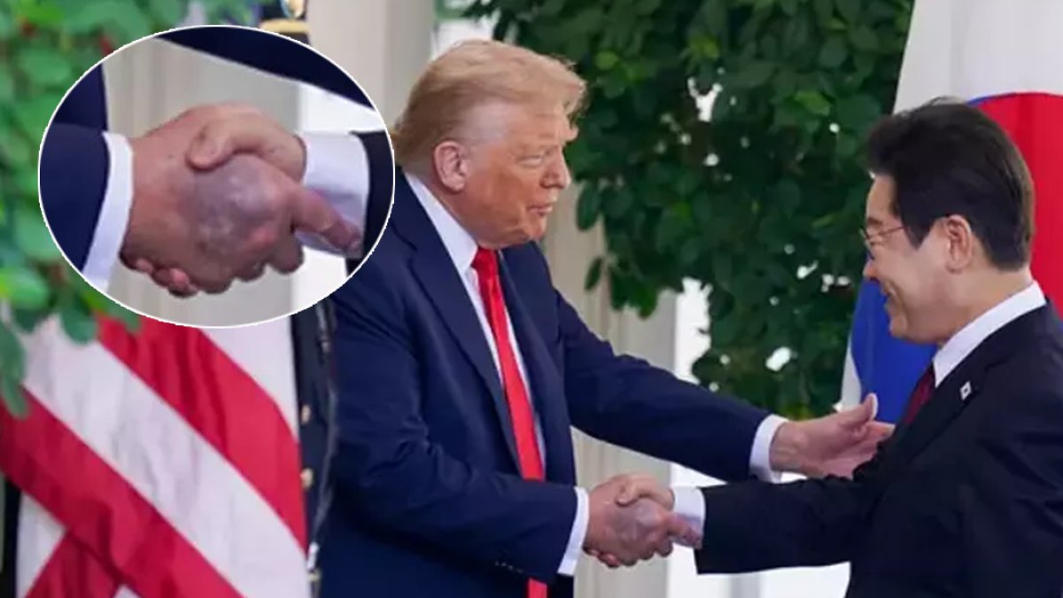 Trump'ın elindeki morluk hakkında Beyaz Saray'dan açıklama: Sık tokalaşma ve aspirin morluğa neden oldu