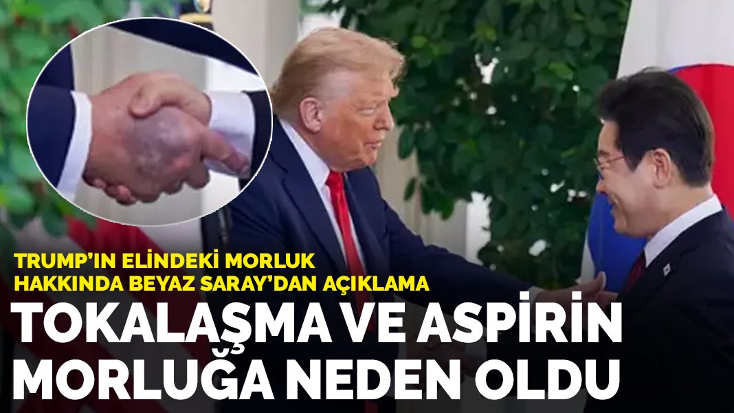 Trump'ın elindeki morluk hakkında Beyaz Saray'dan açıklama: Sık tokalaşma ve aspirin morluğa neden oldu