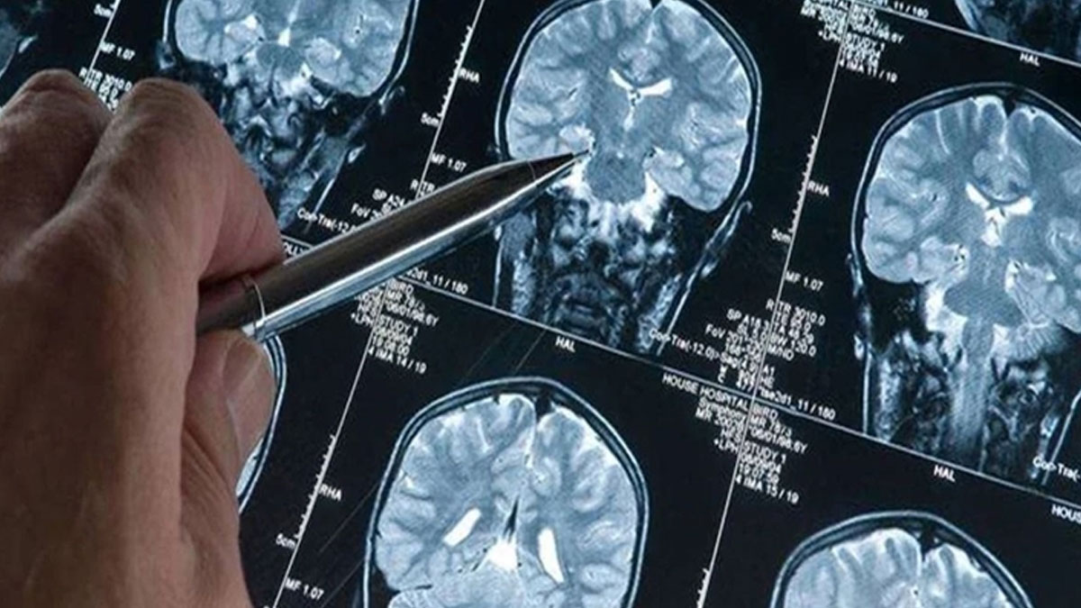 Alzheimer tedavisinde umut veren gelişme: Leqembi evde uygulanabilecek
