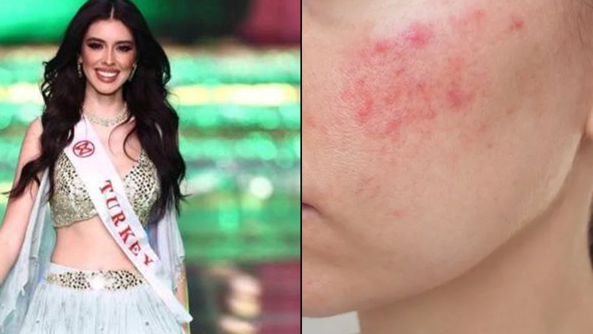 Türkiye güzellik kraliçesinden uyarı: Ben yaptım, siz yapmayın