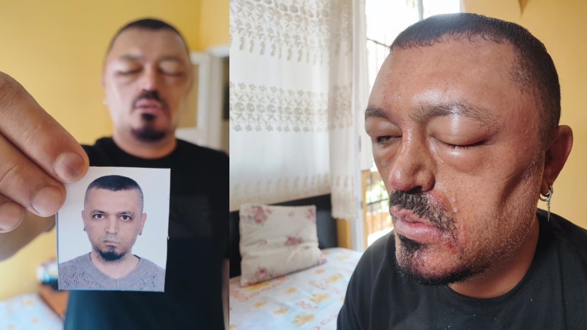 Berber tavsiyesiyle aldığı şampuan hayatını kararttı: Yüzü tanınmaz hale geldi!