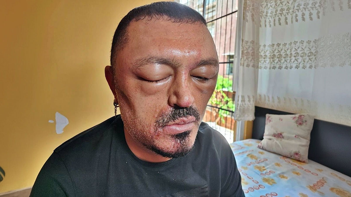 Saç siyahlaştırıcı şampuan kabusu: Gözleri şişti, kafası yara oldu!