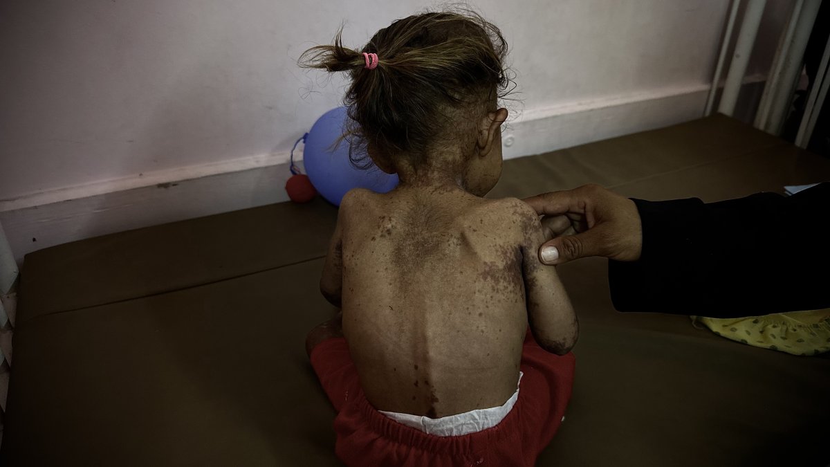 Gazze’de açlık nedeniyle hayatını kaybedenlerin sayısı 425’e yükseldi