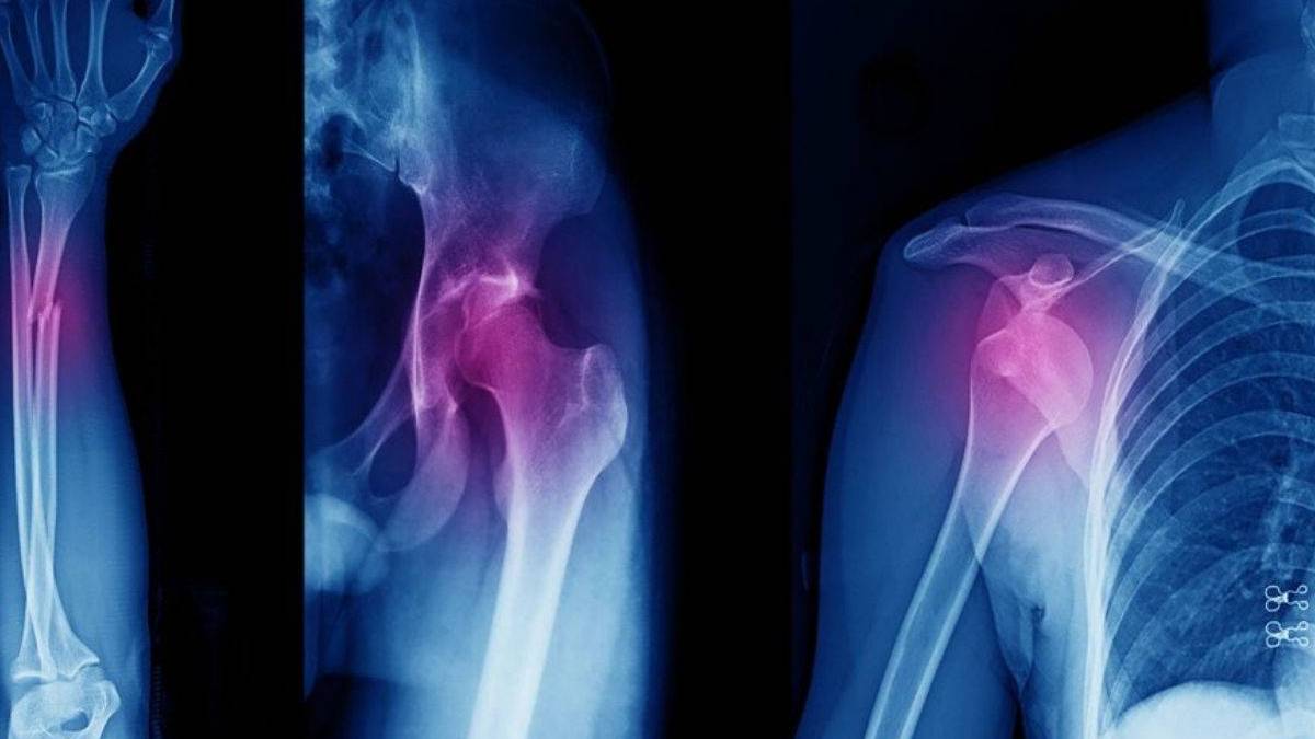 Kırık kemik tedavisinde çığır açan yöntem: Ameliyat sırasında 3D baskı ile anında onarım