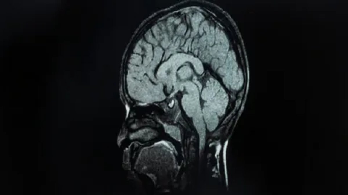 Yapay zekâ, epilepsili çocuklarda gizli beyin lezyonlarını ortaya çıkardı