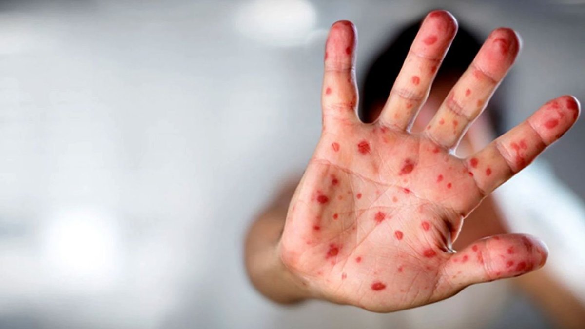 Gana’da Maymun Çiçeği alarmı: Vaka sayısı 583’e yükseldi