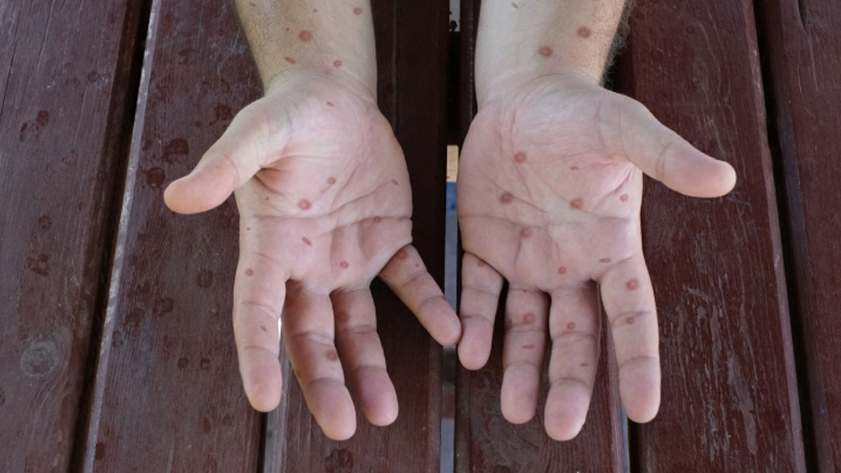 586 vaka sonrası hükümet harekete geçti: Gana'da M çiçeği için aşılama başladı