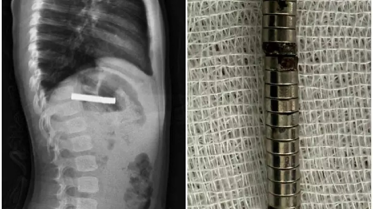 3 yaşındaki çocuk tam 19 mıknatıs yuttu! Yemek borusuna yapışan mıktanıslar Elazığ’da alındı