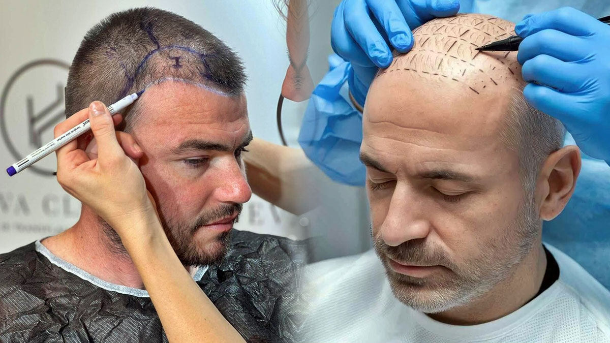 Saç ekimi ameliyatının büyük kısmı artık doktorlar tarafından yapılmayacak!