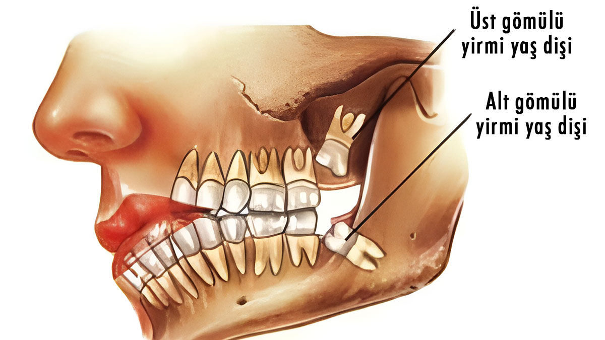 Yirmilik dişler atalarımız için süper güçtü; bizde ise sadece ağrı yapıyor!