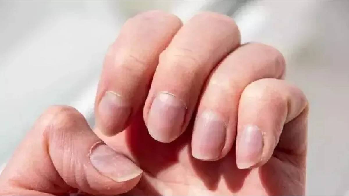 Tırnaklarınız kolay kırılıyorsa bu detaya dikkat: Hayati risk taşıyan hastalığa işaret olabilir!