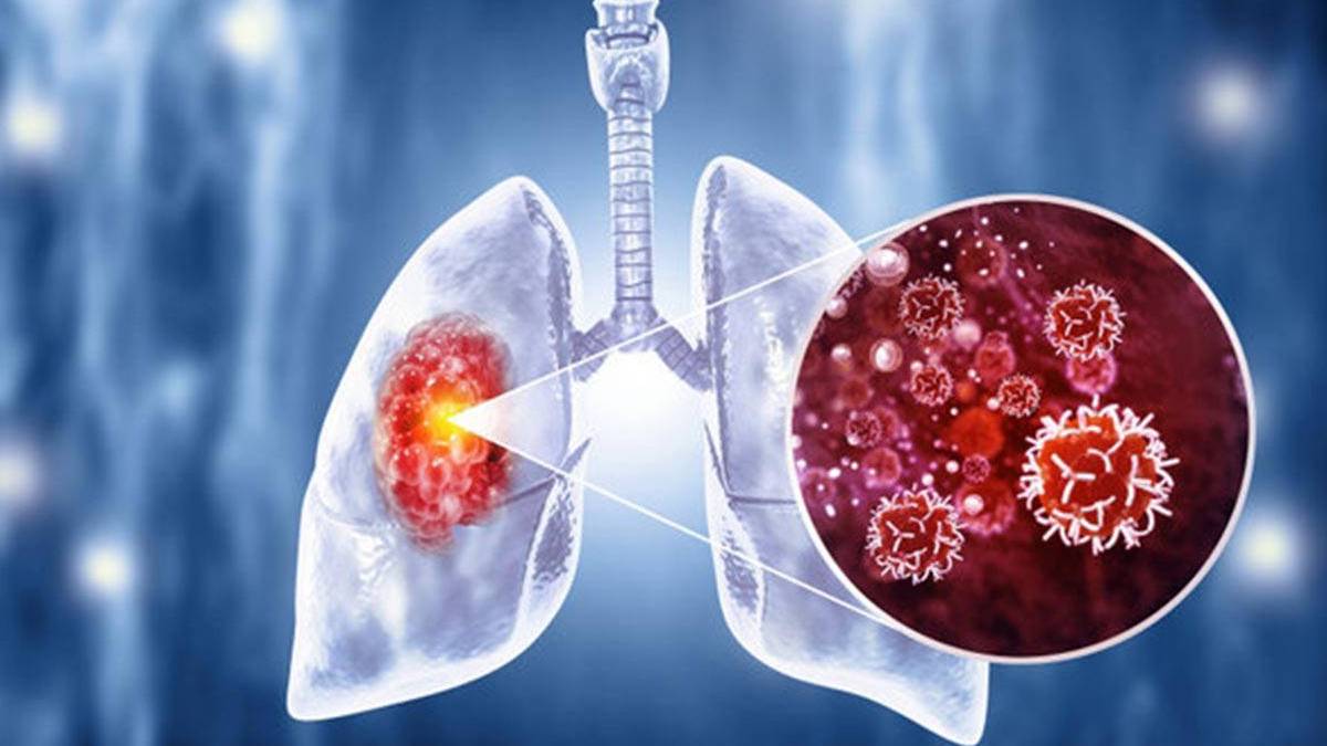 50 yaş üstü sigara içicilerine uyarı: Yıllık tomografi hayat kurtarıyor