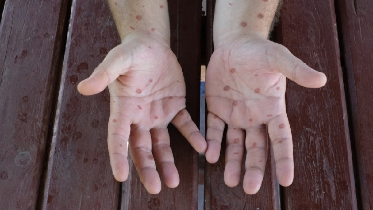 DSÖ'den maymun çiçeği alarmı: 'klad 1b' varyantı daha şiddetli ve ölümcül