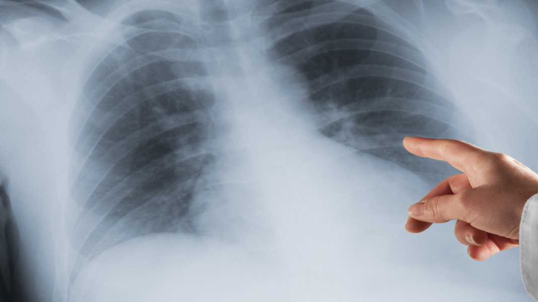 Akciğer kanseri tedavisinde yeni dönem: Kişiselleştirilmiş radyoterapi için 12 gen keşfi