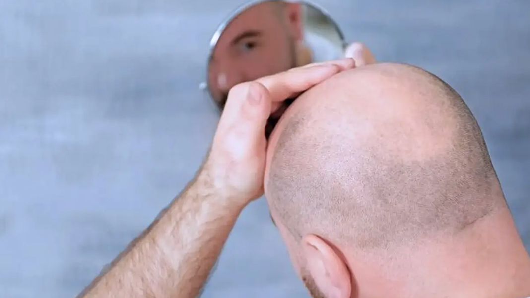 Devrim niteliğinde saç büyüme serumu: 20 günde sonuç veren tedavi klinik denemelere başlıyor