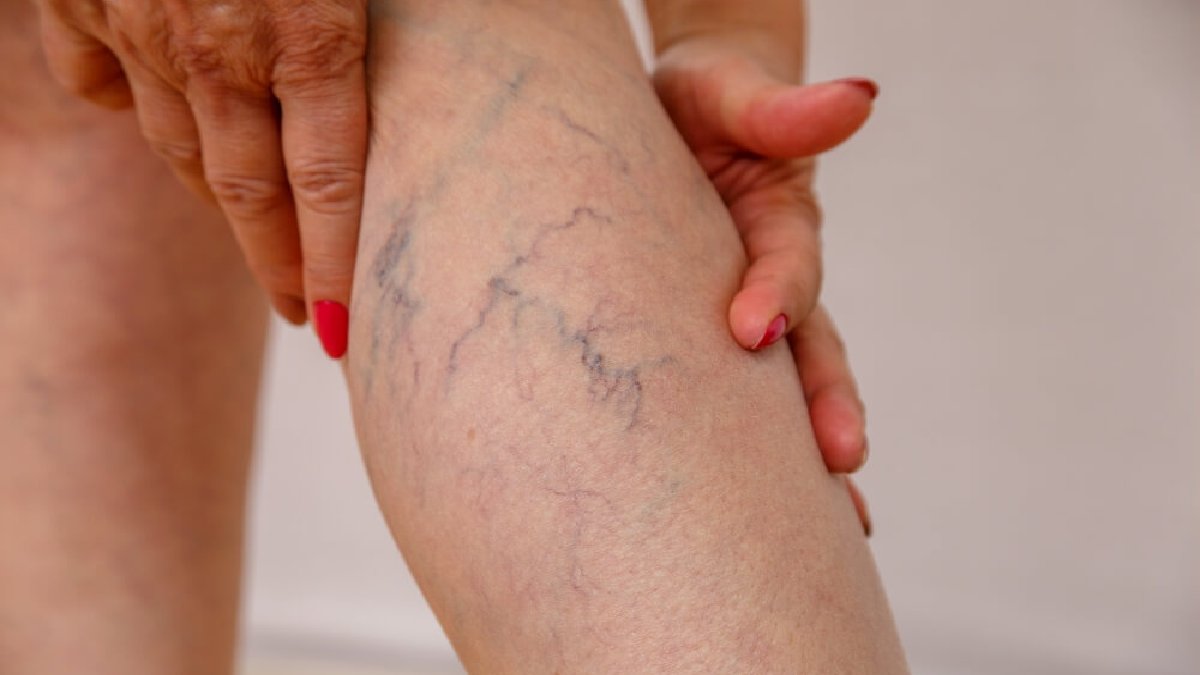 Bacaklarınızda şişlik ve ağrı mı var? Uzman doktor uyardı: Nedeni varis olabilir