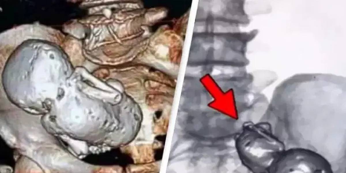 Tam 40 yıl boyunca bebeğini karnında taşıdı! "Taş Bebek" vakası tıp sınırlarını zorladı