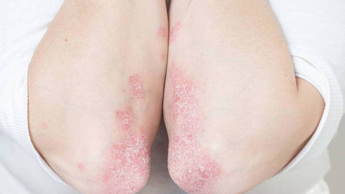 Uzamanlar uyardı: “Kelebek hastalığı” lupus hayati organları etkileyebiliyor