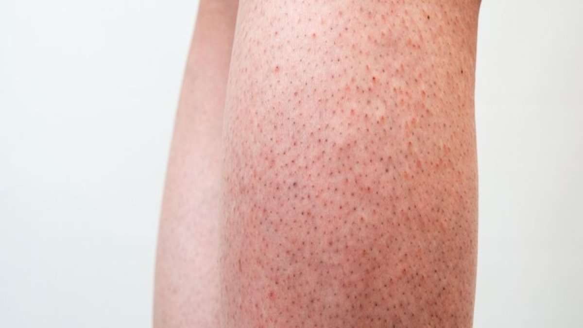 Pürüzsüz cilt hayali gerçek oluyor! Çilek bacak görünümünü tarihe gömecek kesin çözümler