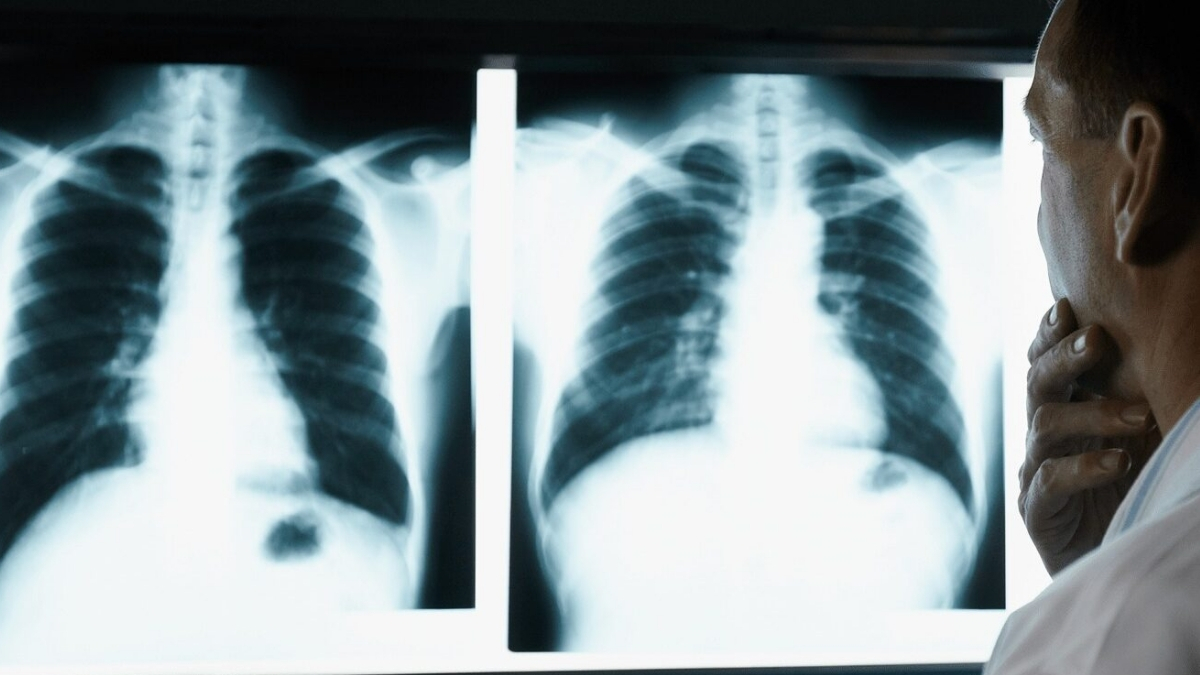 Kanserin en tehlikelisi o! 5 Kanser ölümünden biri bu tür yüzünden: Tetikleyicisi sigara…