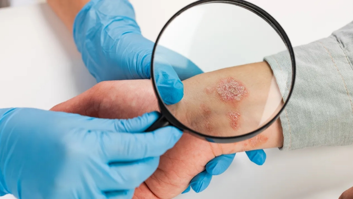 Popüler diye yapılıyor ama kanser riskini artırıyor! Bunu yapmadan önce bir kez daha düşünün: Cilt kanserine yol açıyor