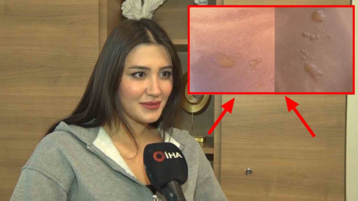 Evdeki gizli tehlike! Sıcak su torbası patladı, genç kadın hastanelik oldu