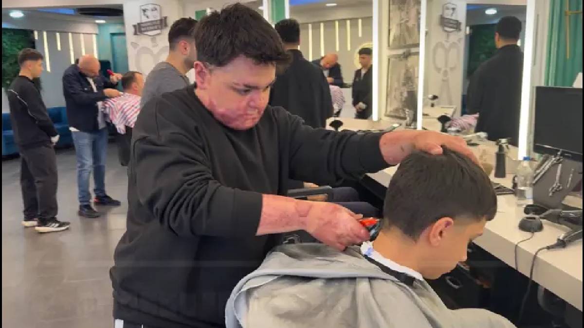 12 gün boyunca uyutuldu, 65 kez ameliyat oldu! Vücudunun neredeyse tamamında yanıklar oluştu